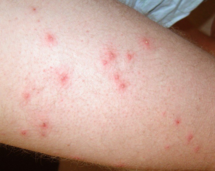 Treatment For Itchy Red Bumps On Skin