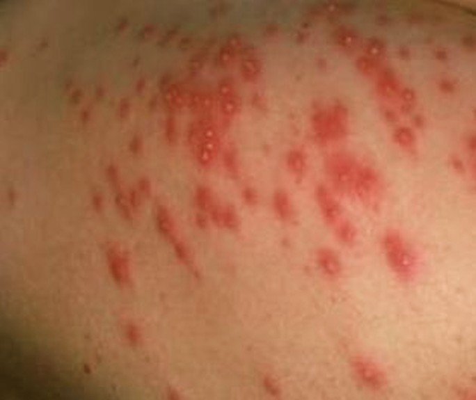 Folliculitis - Mayo Clinic