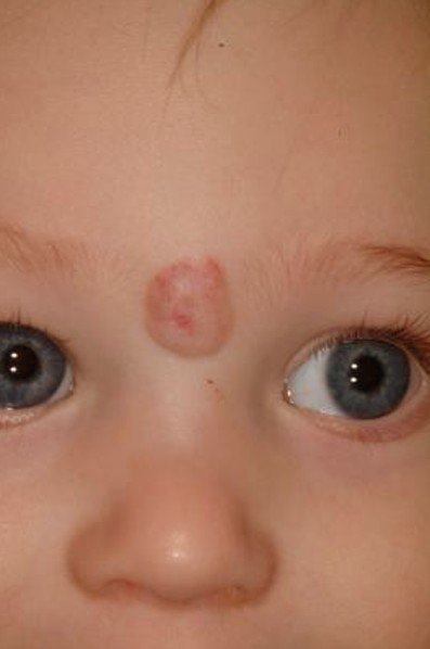 strawberry-hemangioma-pictures-symptoms-causes-treatment