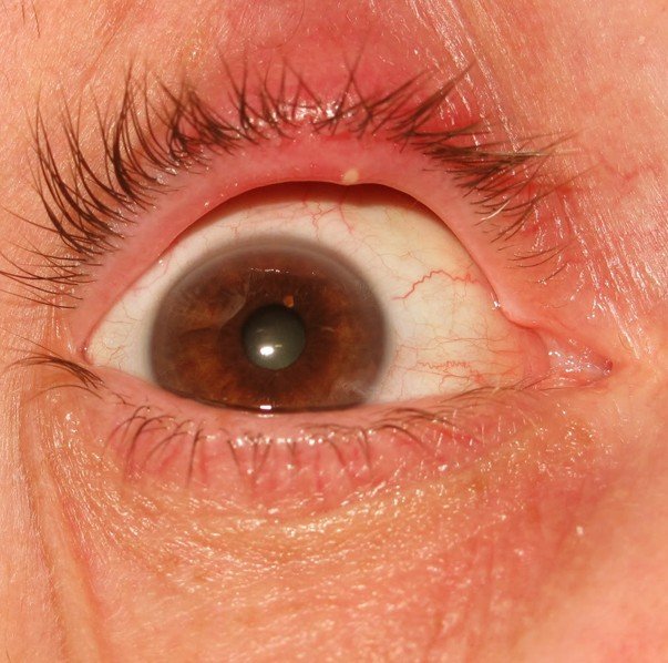 Small Hard Lump Under Eyelid