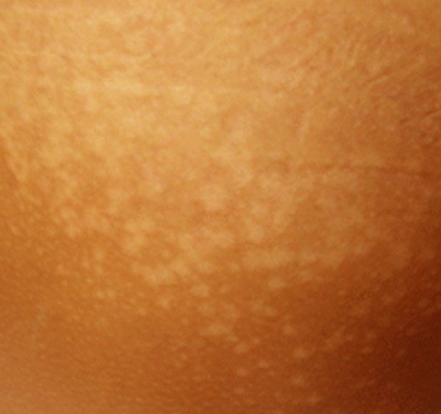 Tinea Versicolor Pictures Contagious Symptoms Treatment