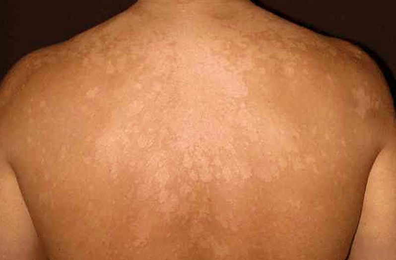 Tinea Versicolor-Topic Overview - WebMD