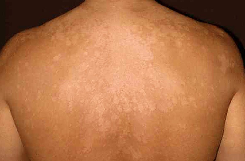 Tinea Versicolor: Causes, Symptoms, & Treatment