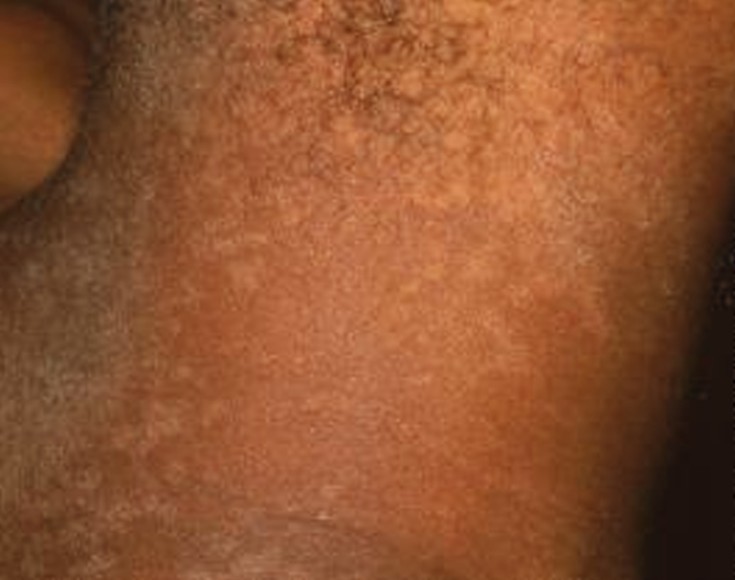 Tinea Versicolor: Cause, Symptoms, and Treatments - WebMD