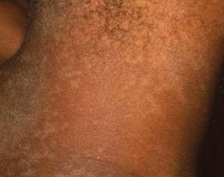 Tinea Versicolor African American Skin Pictures Photos