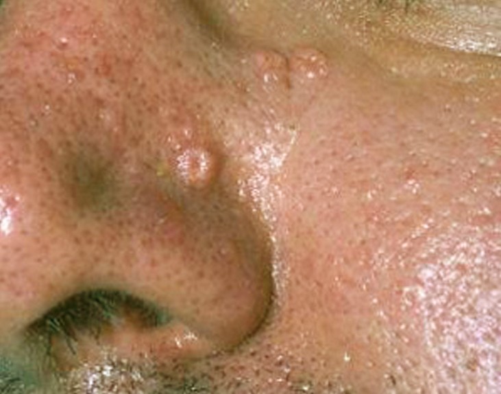 Sebaceous Hyperplasia Pictures Removal Symptoms Treatment Causes