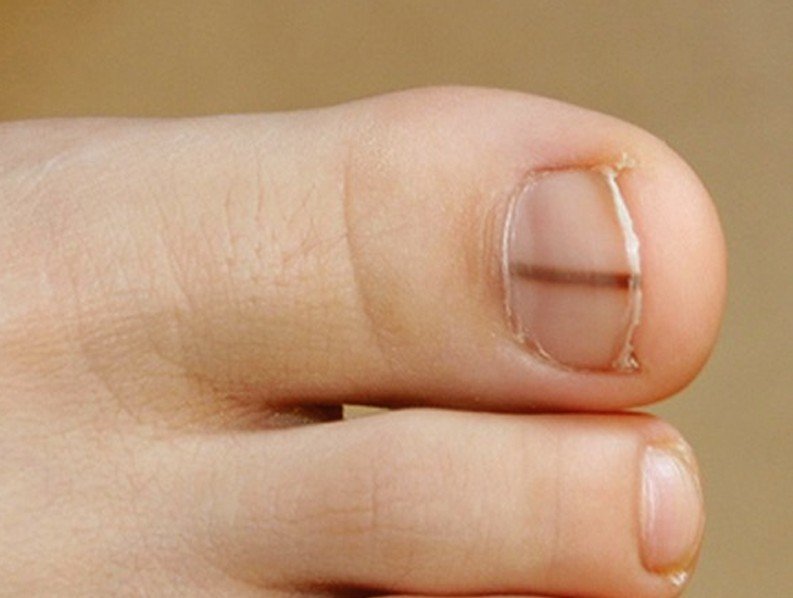 Dark spot under my toe nail | Melanoma Research Foundation