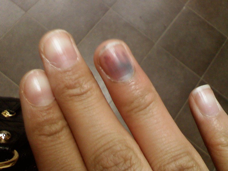 streak in nail