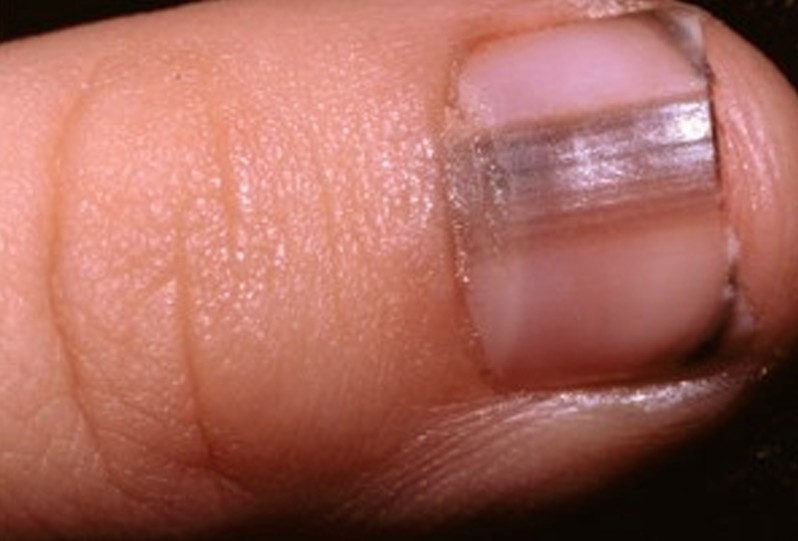 melanoma under the nail