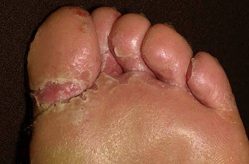 Tinea Pedis - National Library of Medicine - PubMed Health