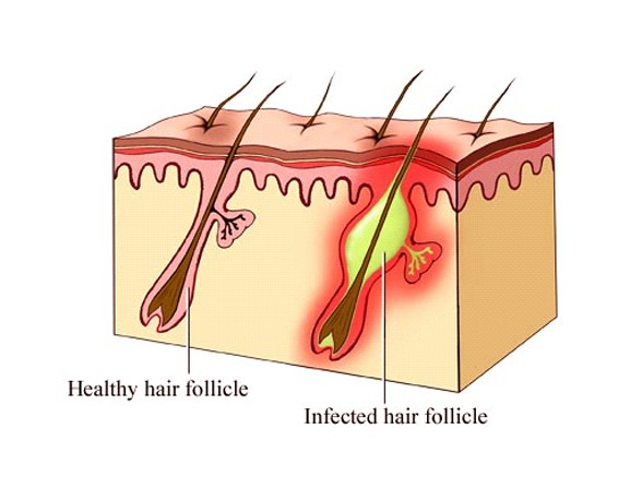 What causes ingrown hairs?