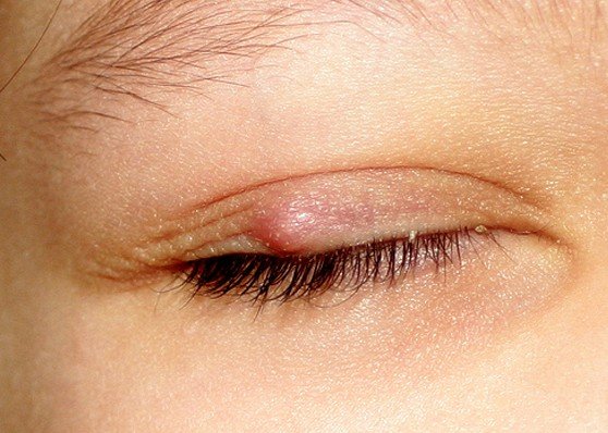 Chalazion Pictures Symptoms Treatment Removal Causes Surgery 