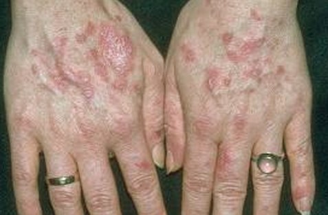 Maculopapular Rash - Definition, Pictures, Causes ...