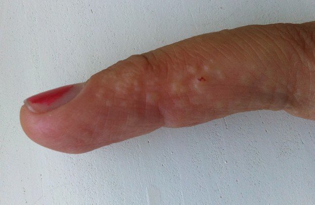 swollen hands & feet combined w/itchy rash - Neurological ...