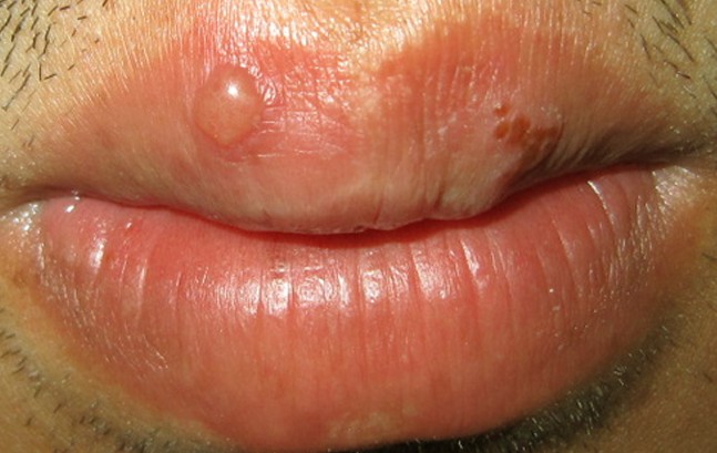 Small fluid filled bumps on lip - Dermatology - MedHelp