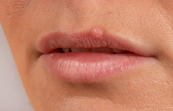 what-causes-sudden-blisters-on-lipsticks-lipstutorial