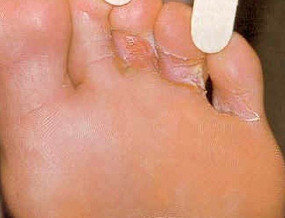 Skin Fungal Infections: Symptoms, Causes, Treatments