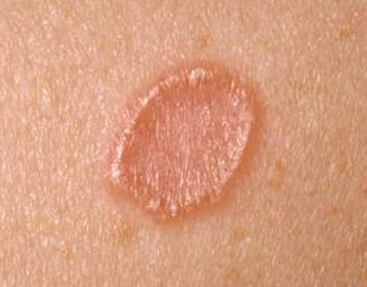 Granuloma Annulare – Treatment, Symptoms, Causes, Pictures ...