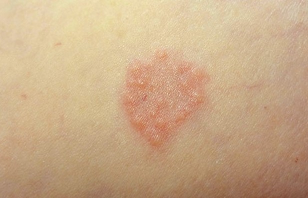 Picture of Granuloma Annulare - WebMD