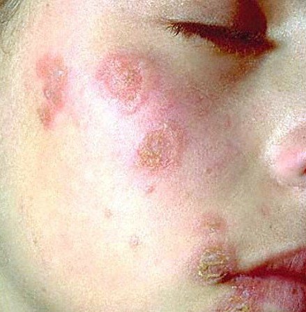 Infantigo Pictures Contagious Causes Symptoms Treatment