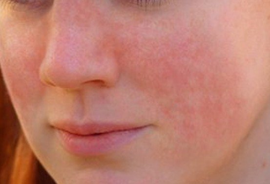 Systemic Lupus Erythematosus (SLE) Picture Lupus Rash