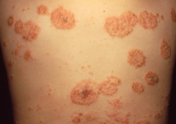 Nummular Eczema Pictures Treatment Causes Symptoms Diagnosis