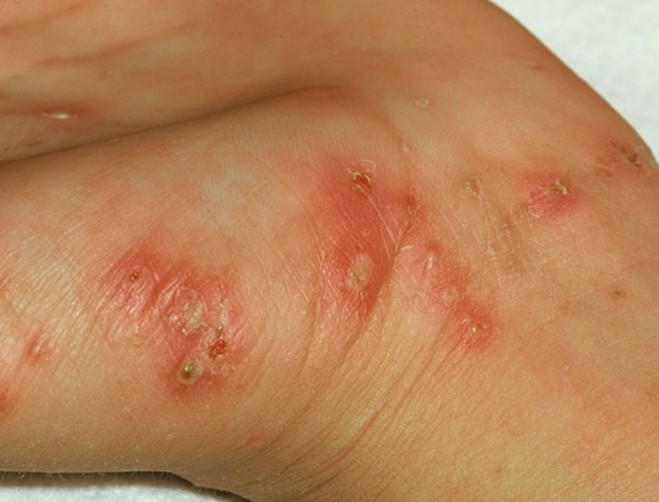 scabies rash photos #10