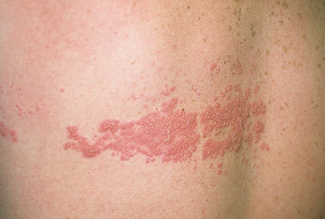 Chickenpox Symptoms and causes - Mayo Clinic