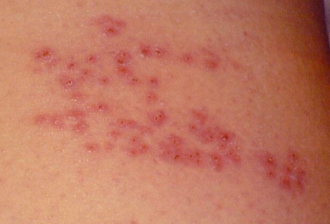Shingles : 9 Pictures, Symptoms, and Treatments - Healthline