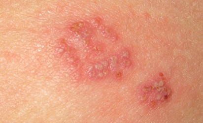 14 Rashes You Need to Know: Common Dermatologic Diagnoses