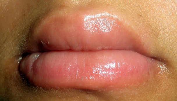 lower lip swelling