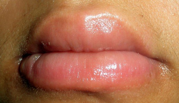 how-to-get-rid-of-swollen-lips-at-home-swollen-lips-treatment-youtube