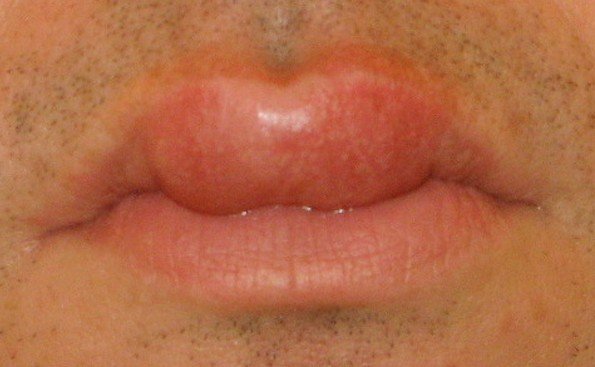 Swollen Lips Causes Treatment Pictures Remedies