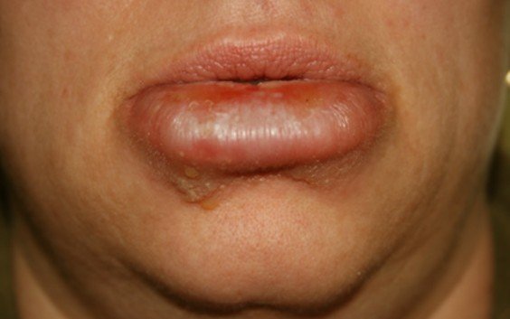 Cyst On Upper Lip Pictures Photos