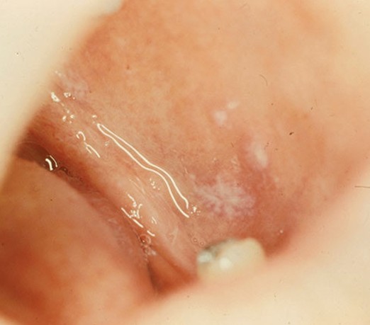White Spots In Back Of Mouth 36