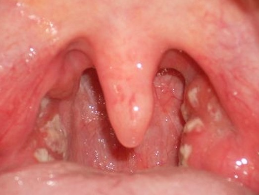 White Spots In Baby Mouth 79