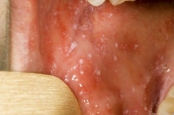 White Spot Inside Mouth 33