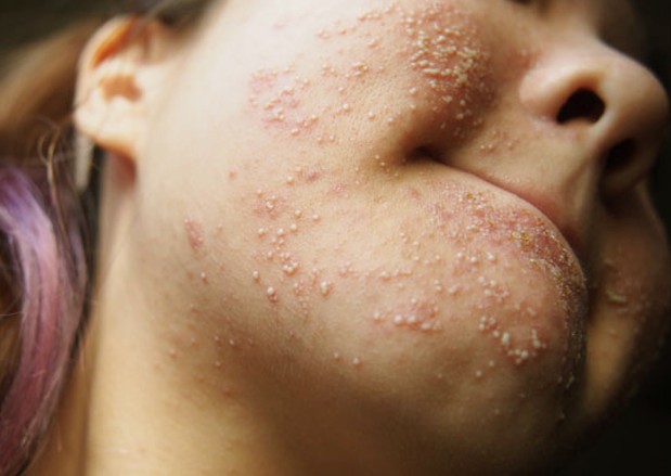allergic reaction skin rash pictures #10