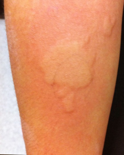 pictures of allergic reactions #10