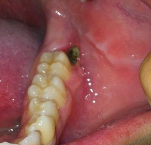 Impacted Wisdom Tooth Abscess Symptoms