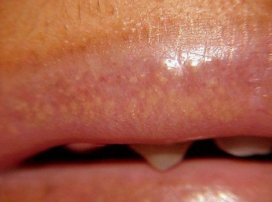 White Bumps On Corner Of Lips