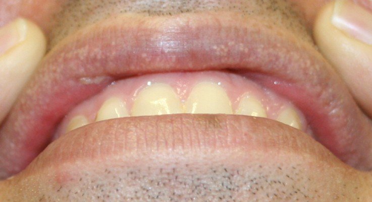 White Spots On Lips Pictures Treatment And Causes