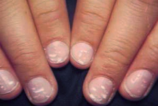 What Do White Flecks On Fingernails Mean