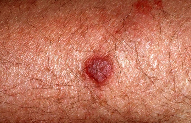 actinic keratosis pictures #11