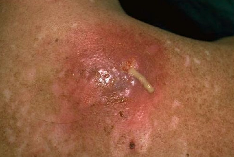 mrsa infection picture #11