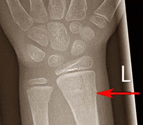 How long does it take a wrist fracture to heal?