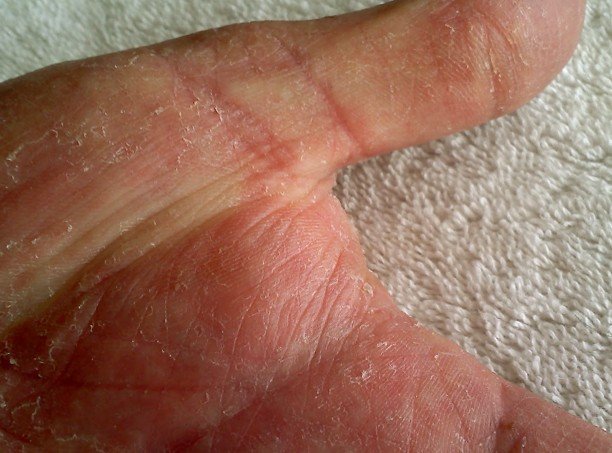 swollen hands & feet combined w/itchy rash - Neurological ...