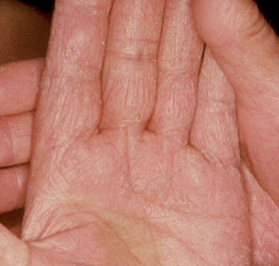 hand-fungus-pictures-symptoms-treatment-and-causes-february-2022