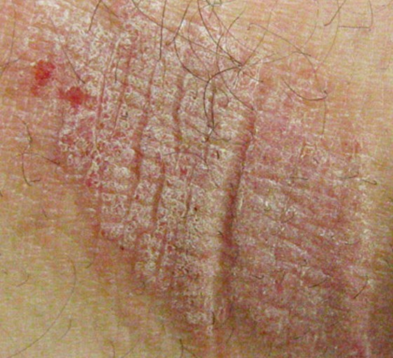 The Many Manifestations of Eczema - Medscape