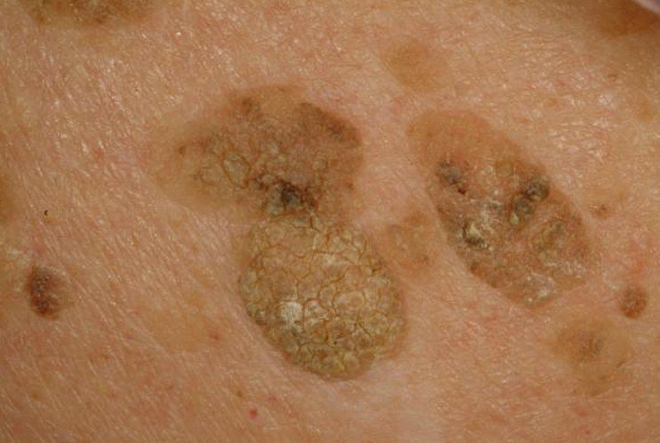 Liver Spots Pictures Face Skin Hands Causes Treatment 